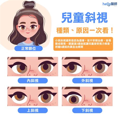 做愛鬥雞眼|斜視、射哩眼和鬥雞眼成因和症狀 如何矯正斜視？ 